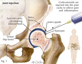 Corticosteroid injection hip