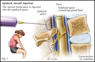 epidural1
