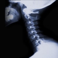 Cervical Spine Epidural Injection 01