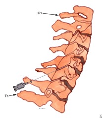 Cervical Spine Epidural Injection 02