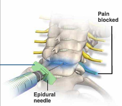 Cervical Spine Epidural Injection 03