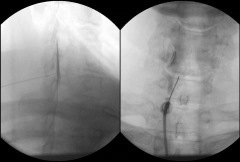 Cervical Spine Epidural Injection 04