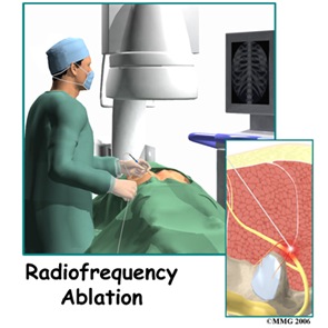 Radiofrequency Ablation of the Medial Branch Nerves 02