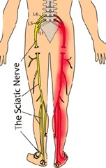 Lumbar Radiculopathy - Best Pain Doctor NYC