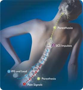 Spinal-Cord-Stimulator