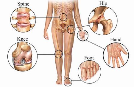 What is Arthritis?