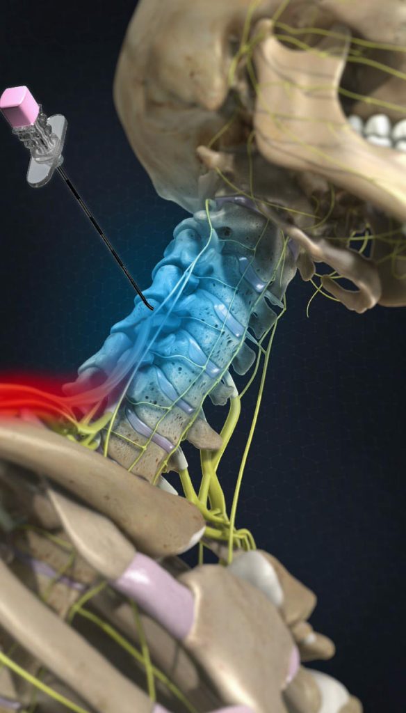 Radiofrequency Ablation Treatment for Cervical Medial Branch Pain