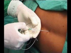lower-thoracic-epidural-steroid-injection-information-specialist-02