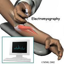 electromyography-EMG-best-doctor-nyc-01