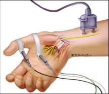 electromyography-EMG-information-procedure-specialist-nyc-02
