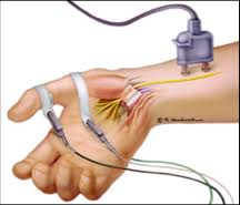 emg test for foot pain emg test for foot pain