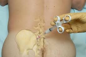 What about Sacroiliac Joint Pain and Injection?