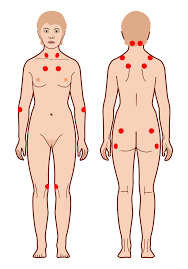 what-is-fibromyalgia-01