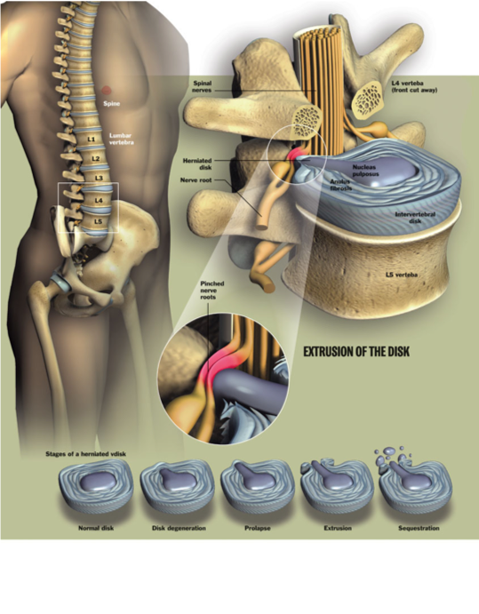 herniated disk doctor