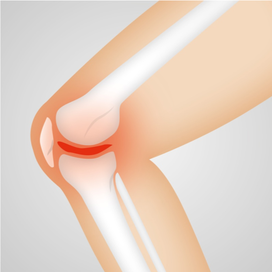 Knee Pain - Types of Conditions